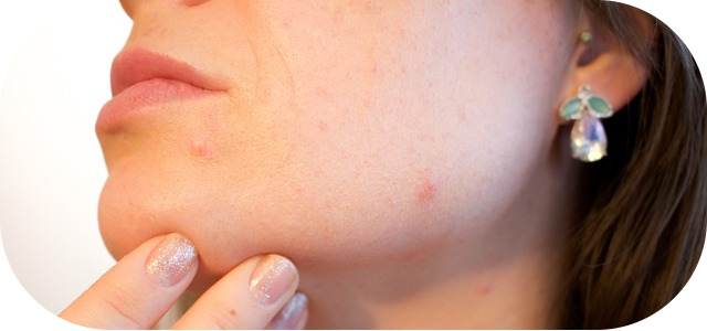 boutons sur le visage
