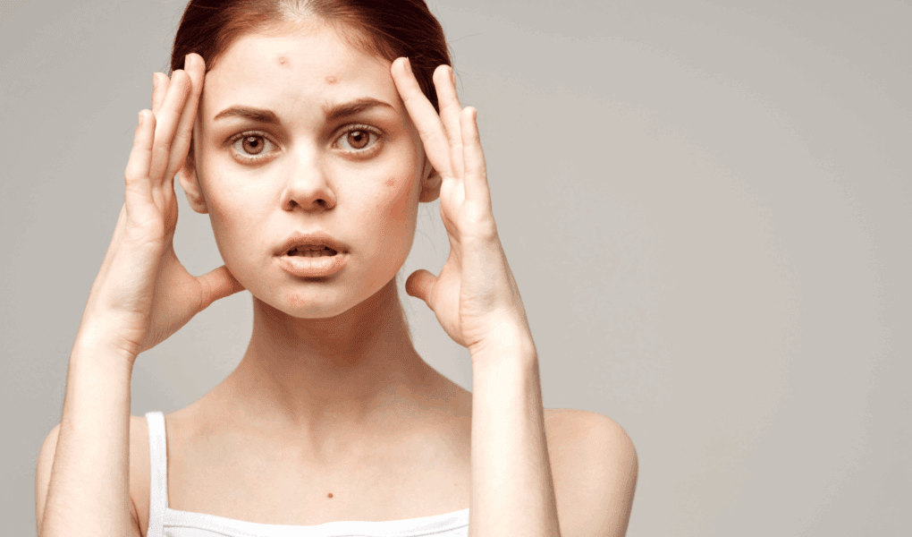 imperfections post été