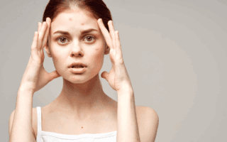 imperfections post été