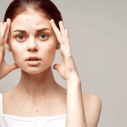 imperfections post été