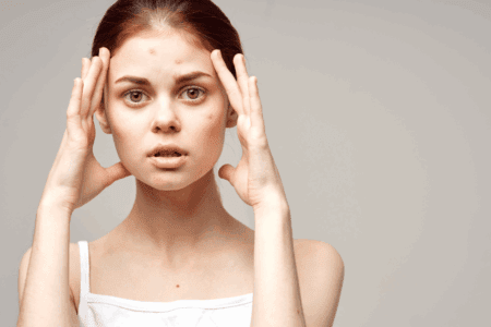 imperfections post été